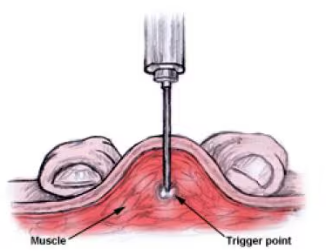 Trigger Point Injections: Purpose, Benefits, Side Effects, Cost, Time to Work