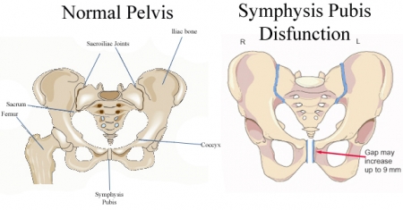 Pelvic Pain (Symphysis Pubis Dysfunction): Symptoms, Causes, Treatment, Exercises
