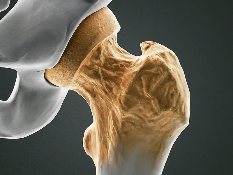 Hip Osteoarthritis: Signs, Symptoms, and Path to Recovery