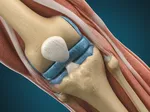STARR Technique and Ligament Regeneration