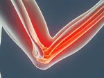 Understanding Bursitis: What to Do When Your Elbow is Swollen but Not Painful
