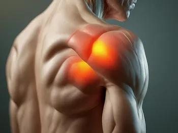 Shoulder Impingement Syndrome: What It Is and How to Fix It