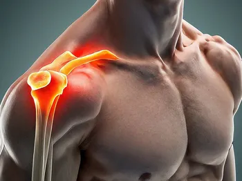 Acromioclavicular Impingement