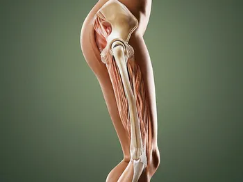 Natural Remedies for Managing Gluteal Tendinopathy Pain