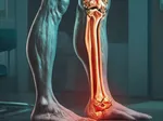 Achilles Tendinopathy: Overuse or Under-Recovery?
