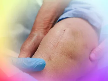 When knee cartilage repair is worth considering