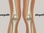 Understanding Autograft vs Allograft: Which Is Better for You?