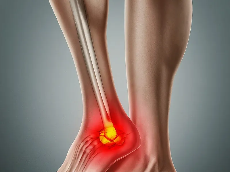 Plantar Fasciitis Explained: Insights on Causes, Symptoms, and Treatments