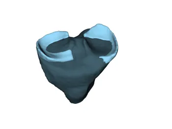 Advance Meniscus Repair