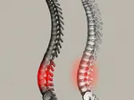 Exploring the Connection Between Spondylolisthesis and Spondylolysis