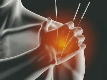 Evaluating the Effectiveness of Acupuncture in Alleviating Shoulder Pain and Improving Range of Motion