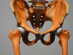 Impact of Iliopsoas Bursitis on Daily Life and Mobility