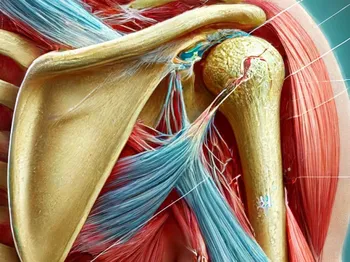 Shoulder Impingement Syndrome: Causes, Symptoms, and Treatment Options