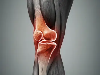 Identifying PCL Injury Symptoms for Timely Intervention
