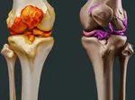 Comparing Osteoarthritis and Rheumatoid Arthritis: Pain Differences