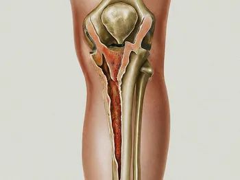 Rehabilitation After a Tibia Plateau Fracture: What to Expect