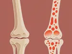 How to Diagnose, Treat, and Prevent Osteoporosis Effectively