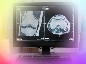 ChondroFiller or Arthrosamid for your knee