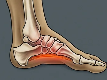 Top Causes of Plantar Fasciitis and How to Avoid Them