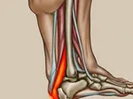 Understanding Achilles Tendon Rupture: Symptoms, Causes, and Repair Techniques