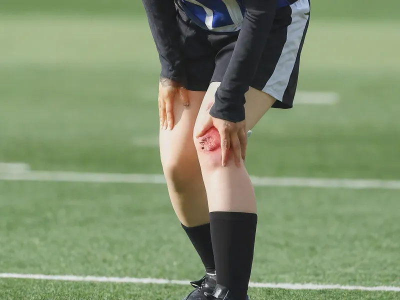 Proven Prevention Strategies for ACL Tears in Athletes