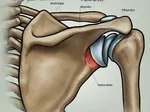 Identifying SLAP Lesions: Key Symptoms and When to Seek Medical Help