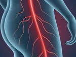 The Role of Exercise and Physical Therapy in Managing Sciatica