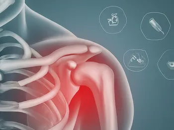Shoulder Impingement Syndrome: Causes, Symptoms, and Treatment Options