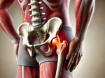 Understanding Osteoarthritis of the Hip: Impacts, Recovery, and Prevention