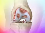 ChondroFiller™ durability compared with Arthrosamid