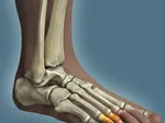 Understanding Talar Dome Lesions of the Ankle