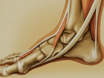 Recognizing the Signs Plantar Fasciitis Is Healing: Progress and Setbacks Explained