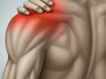 Understanding Mild Subacromial Subdeltoid Bursitis: Causes and Risk Factors