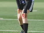 Proven Prevention Strategies for ACL Tears in Athletes
