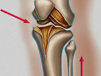 Understanding Tibia Plateau Fracture: Causes and Risk Factors