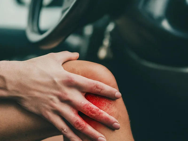 PCL Injury Rehabilitation: Effective Exercises and Recovery Timelines