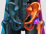 Exploring Symptoms and Signs of a Torn Hip Labrum