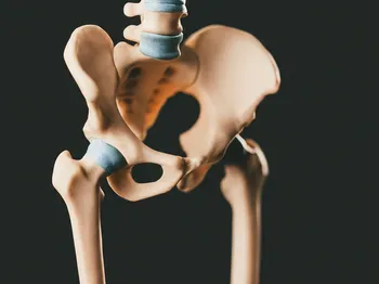 Understanding Iliopsoas Bursitis: A Comprehensive Overview