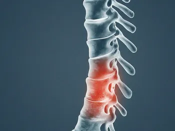 Understanding Spondylolisthesis: A Guide to Causes and Risk Factors