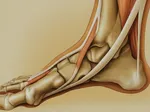 Recognizing the Signs Plantar Fasciitis Is Healing: Progress and Setbacks Explained