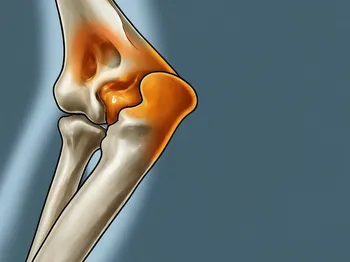 Managing Fluid Build-Up in the Elbow: Causes, Symptoms, and Effective Solutions