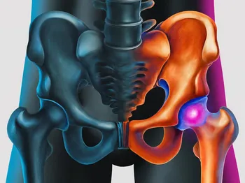 Exploring Symptoms and Signs of a Torn Hip Labrum
