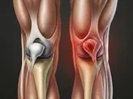 Sports-Related Meniscus Tear Injuries: Prevention and Management