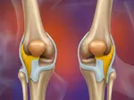 The Role of Rehabilitation in Recovering from Knee Cartilage Damage