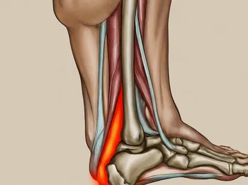 Understanding Achilles Tendon Rupture: Symptoms, Causes, and Repair Techniques
