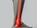 Understanding the Main Causes of Achilles Tendon Pain: What Triggers The Discomfort?
