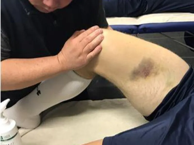 Quadriceps Contusion: Symptoms, Causes, Treatment, Exercises