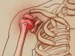 Frozen Shoulder: What to Expect and How to Speed Up Recovery