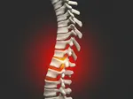 Bertolotti Syndrome: Understanding a Hidden Cause of Lower Back Pain