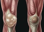 What is a Baker's Cyst? Causes, Symptoms, and Treatments